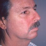 Facial Rejuvenation Before & After Patient #112