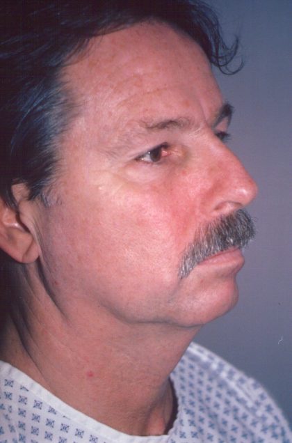 Facial Rejuvenation Before & After Patient #112