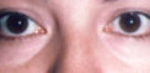 Lower Eyelids Before & After Patient #962