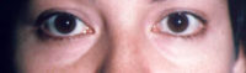 Lower Eyelids Before & After Patient #962
