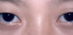 Asian Eyes Before & After Patient #1000