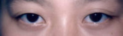 Asian Eyes Before & After Patient #1000