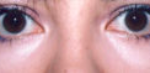 Lower Eyelids Before & After Patient #962