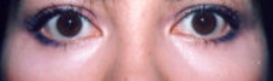 Lower Eyelids Before & After Patient #962