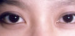 Asian Eyes Before & After Patient #1000