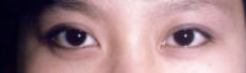 Asian Eyes Before & After Patient #1000