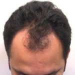 Hair Restoration & Reconstruction Before & After Patient #1044