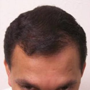 Hair Restoration & Reconstruction Before & After Patient #1044