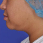 Facial Rejuvenation Before & After Patient #82