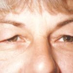 Eyelid and Brow Lift Before & After Patient #924
