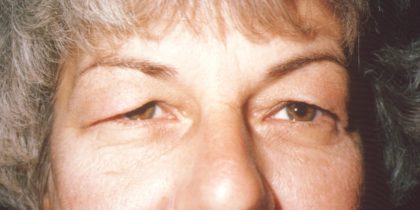 Eyelid and Brow Lift Before & After Patient #924