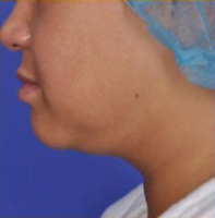 Facial Rejuvenation Before & After Patient #82