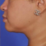 Facial Rejuvenation Before & After Patient #82