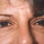 Eyelid and Brow Lift Before & After Patient #924