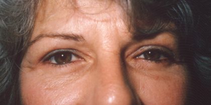 Eyelid and Brow Lift Before & After Patient #924