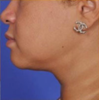 Facial Rejuvenation Before & After Patient #82