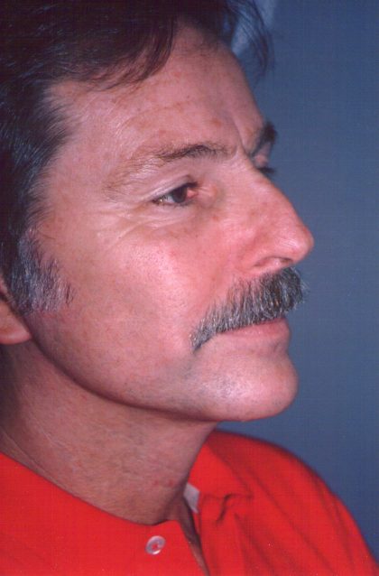 Facial Rejuvenation Before & After Patient #112