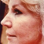 Facial Rejuvenation Before & After Patient #91
