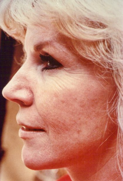 Facial Rejuvenation Before & After Patient #91
