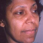 Facial Rejuvenation Before & After Patient #111