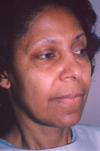 Facial Rejuvenation Before & After Patient #111