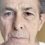 Non-Surgical Facelifts Before & After Patient #833
