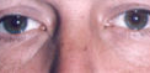Lower Eyelids Before & After Patient #961