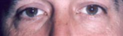 Lower Eyelids Before & After Patient #961