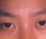 Asian Eyes Before & After Patient #999