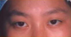 Asian Eyes Before & After Patient #999