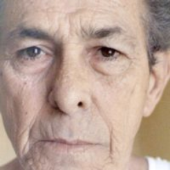 Non-Surgical Facelifts Before & After Patient #833