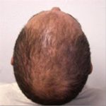 Hair Restoration & Reconstruction Before & After Patient #1043
