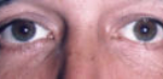 Lower Eyelids Before & After Patient #961