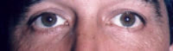 Lower Eyelids Before & After Patient #961