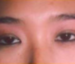 Asian Eyes Before & After Patient #999