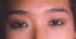Asian Eyes Before & After Patient #999