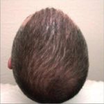 Hair Restoration & Reconstruction Before & After Patient #1043