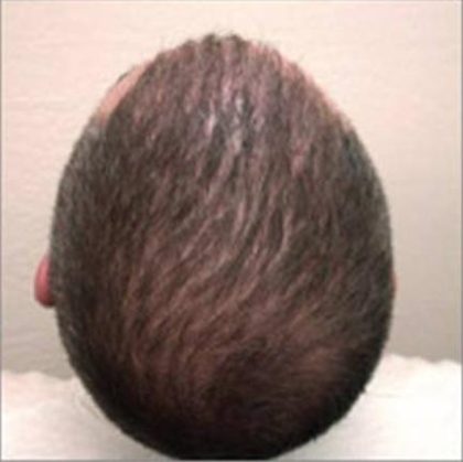 Hair Restoration & Reconstruction Before & After Patient #1043