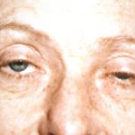 Eyelid and Brow Lift Before & After Patient #923
