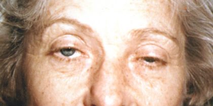 Eyelid and Brow Lift Before & After Patient #923