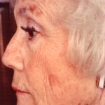 Non-Surgical Facelifts Before & After Patient #832