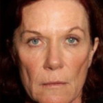 Facial Rejuvenation Before & After Patient #78