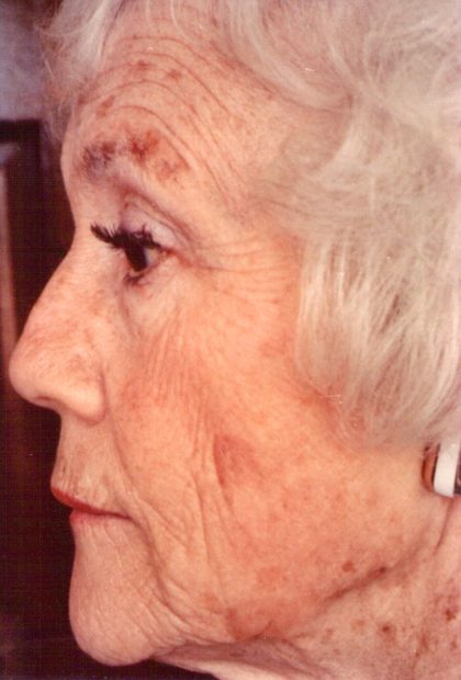 Non-Surgical Facelifts Before & After Patient #832