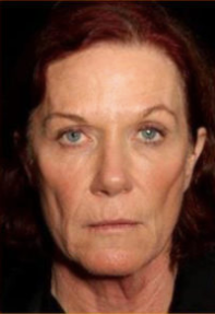 Facial Rejuvenation Before & After Patient #78