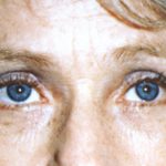 Eyelid and Brow Lift Before & After Patient #923
