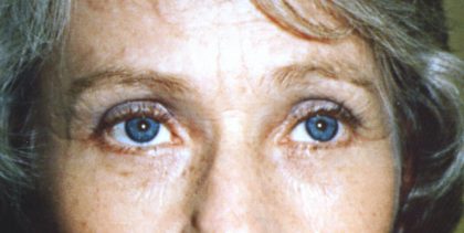 Eyelid and Brow Lift Before & After Patient #923