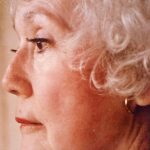 Non-Surgical Facelifts Before & After Patient #832