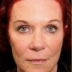 Facial Rejuvenation Before & After Patient #78