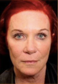 Facial Rejuvenation Before & After Patient #78