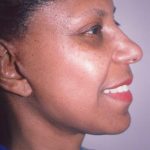 Facial Rejuvenation Before & After Patient #111